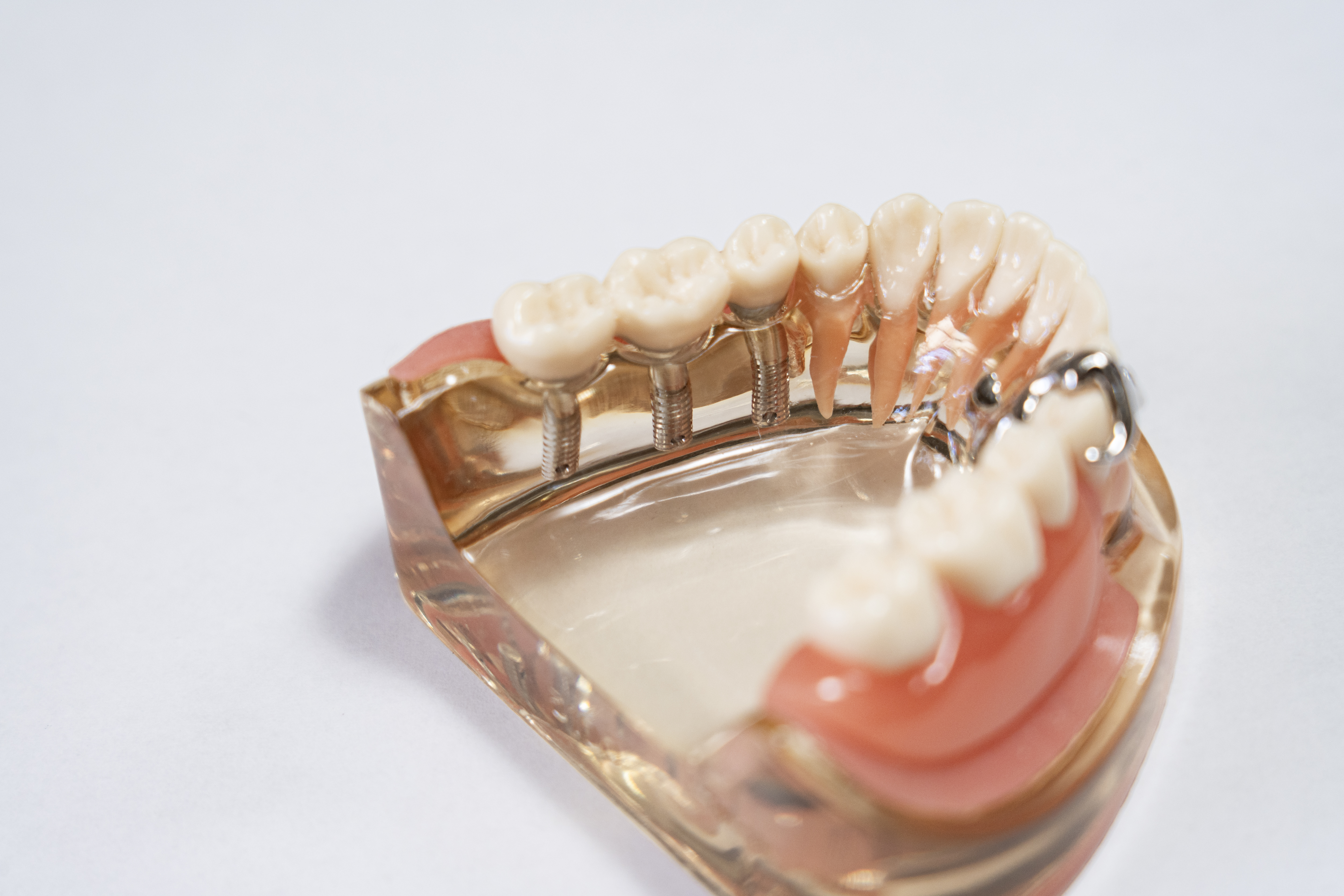 歯科の自由診療で使用する補綴物の模型